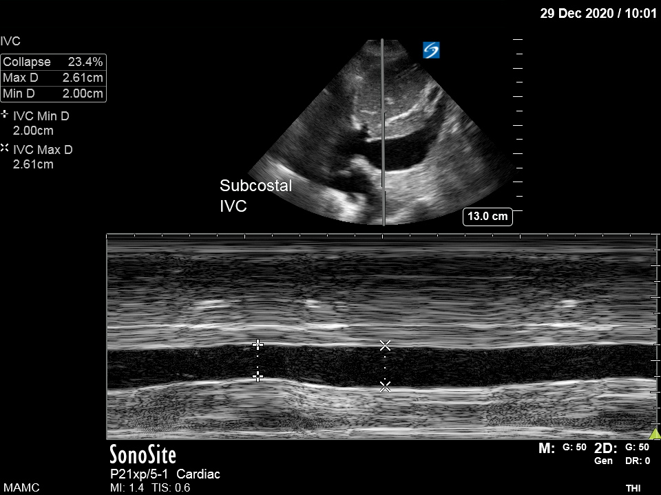 M-Mode showing motion through a single beam path