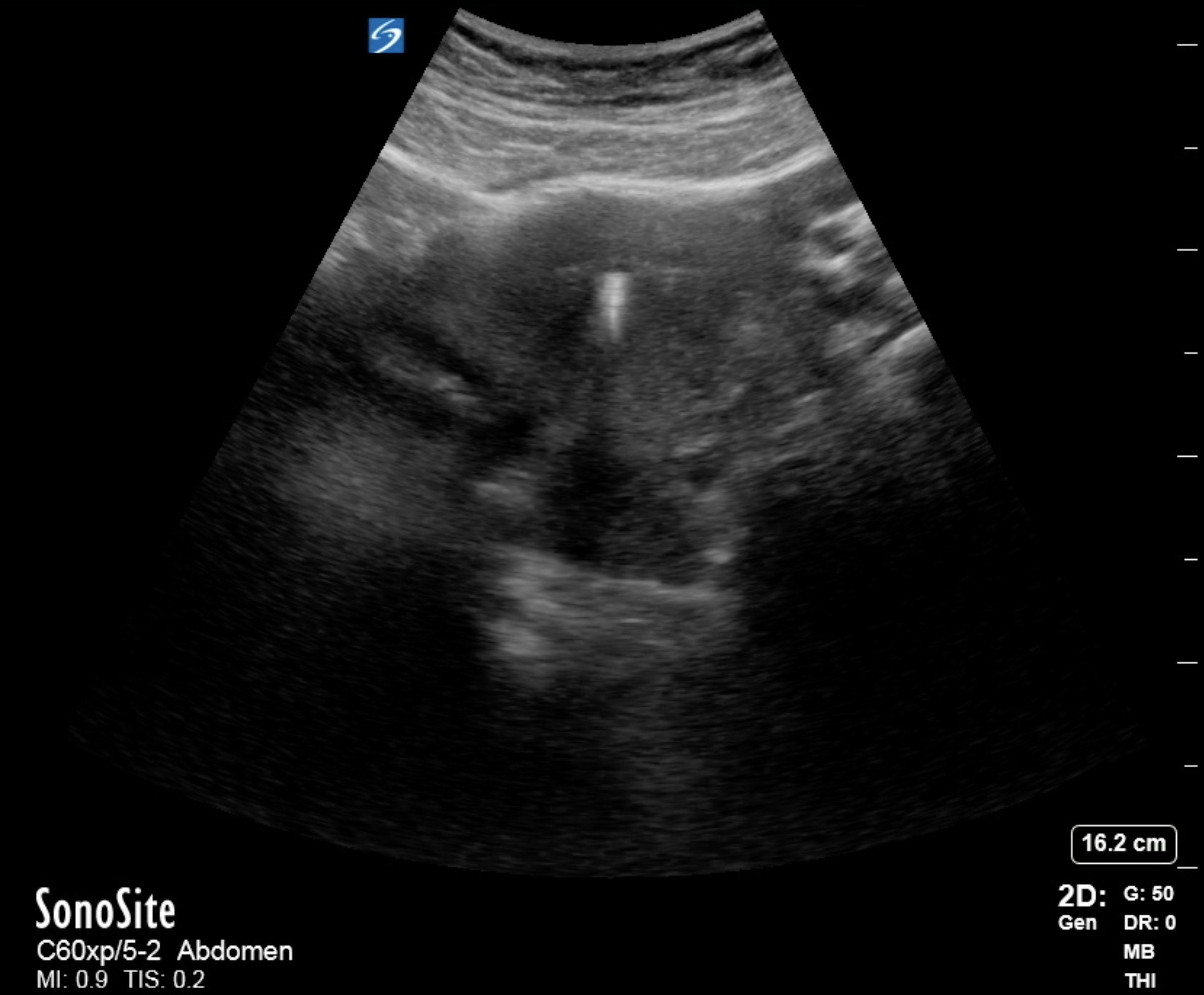 Intrauterine device in short axis displaying hyperechoic reflection with deep shadowing.