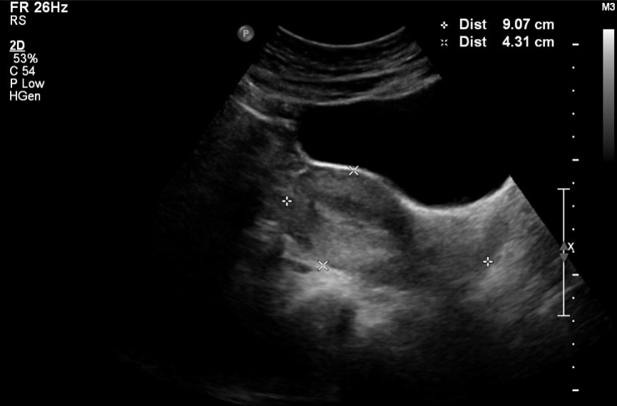 Ultrasound uterus sagittal, anteverted and anteflexed orientation