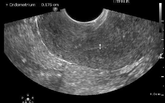 <p>Thin Endometrial Stripe, Postmenopausal Patient