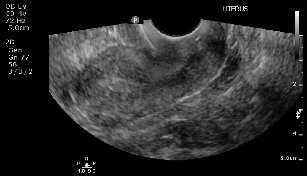 <p>Thickened Endometrial Stripe, Postmenopausal Patient