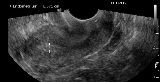 <p>Ultrasound Measuring Endometrial Stripe in Sagittal View of the Uterus.</p>