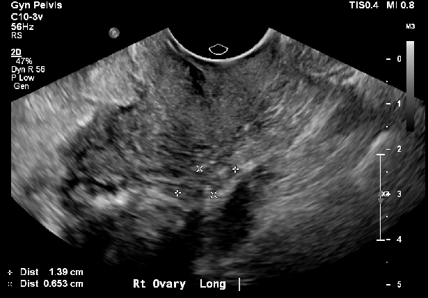 <p>Ovary With Small Follicles, Postmenopausal Patient&nbsp;</p>