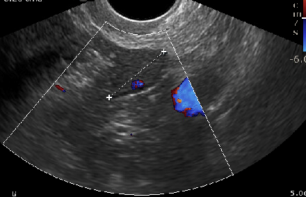 <p>Ovary Without&nbsp;Follicles, Postmenopausal&nbsp;Patient&nbsp;</p>