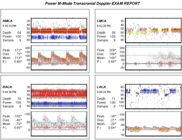 Transcranial Doppler demonstrates elevated mean flow velocity in the left MCA, correlating with mild to moderate vasospasm.