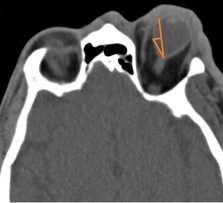 <p>Retrobulbar Hematoma With Proptosis Noted on Computed Tomography.</p>