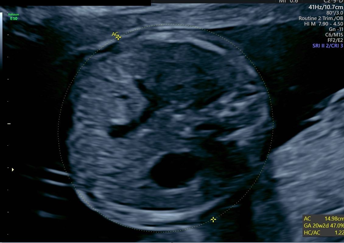 An ultrasound image demonstrating a fetal abdominal circumference with an estimated gestational age of 20 weeks and 2 days.