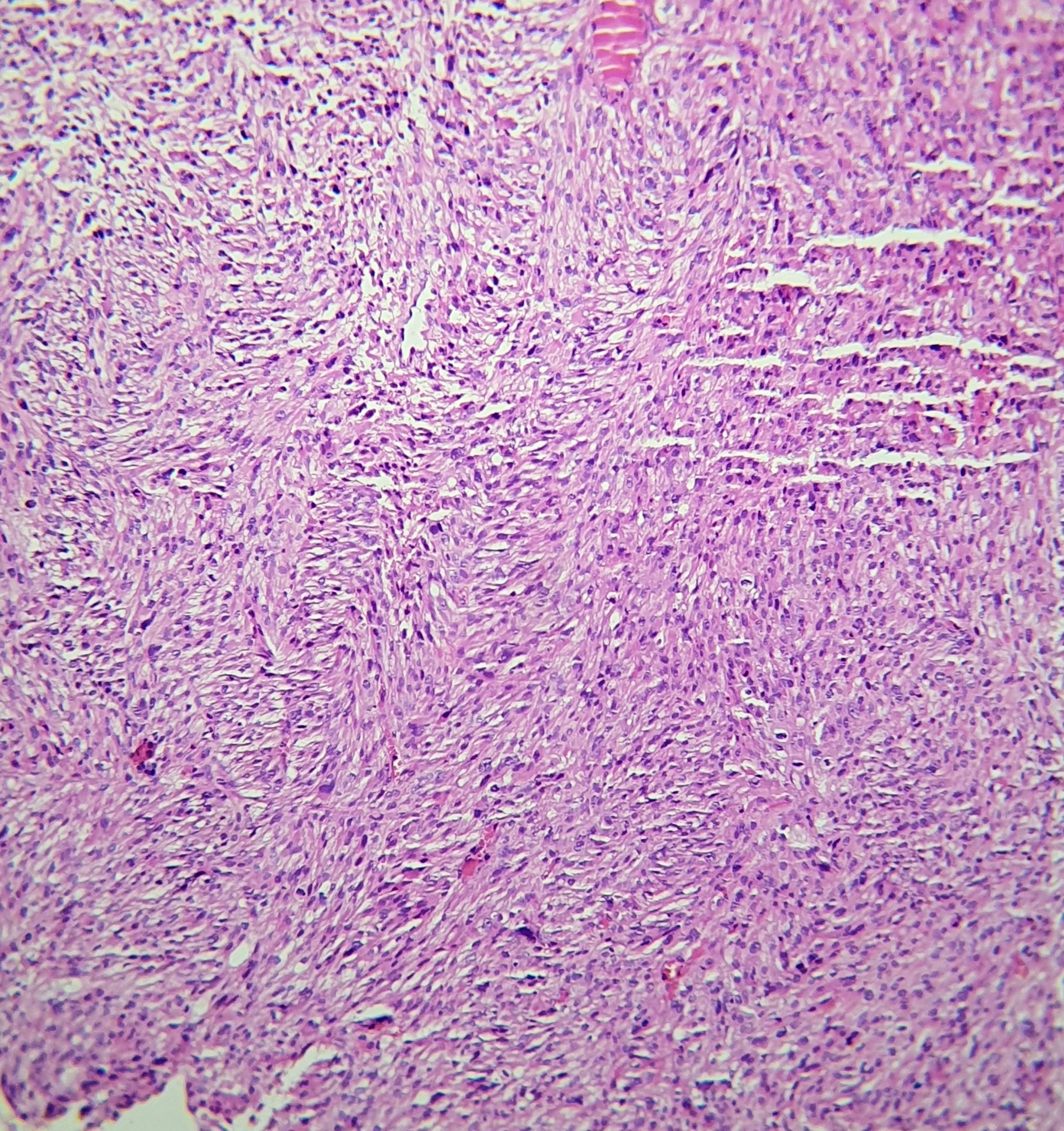 Undifferentiated pleomorphic sarcoma. Bundles of atypical neoplastic cells arranged in a storiform pattern.