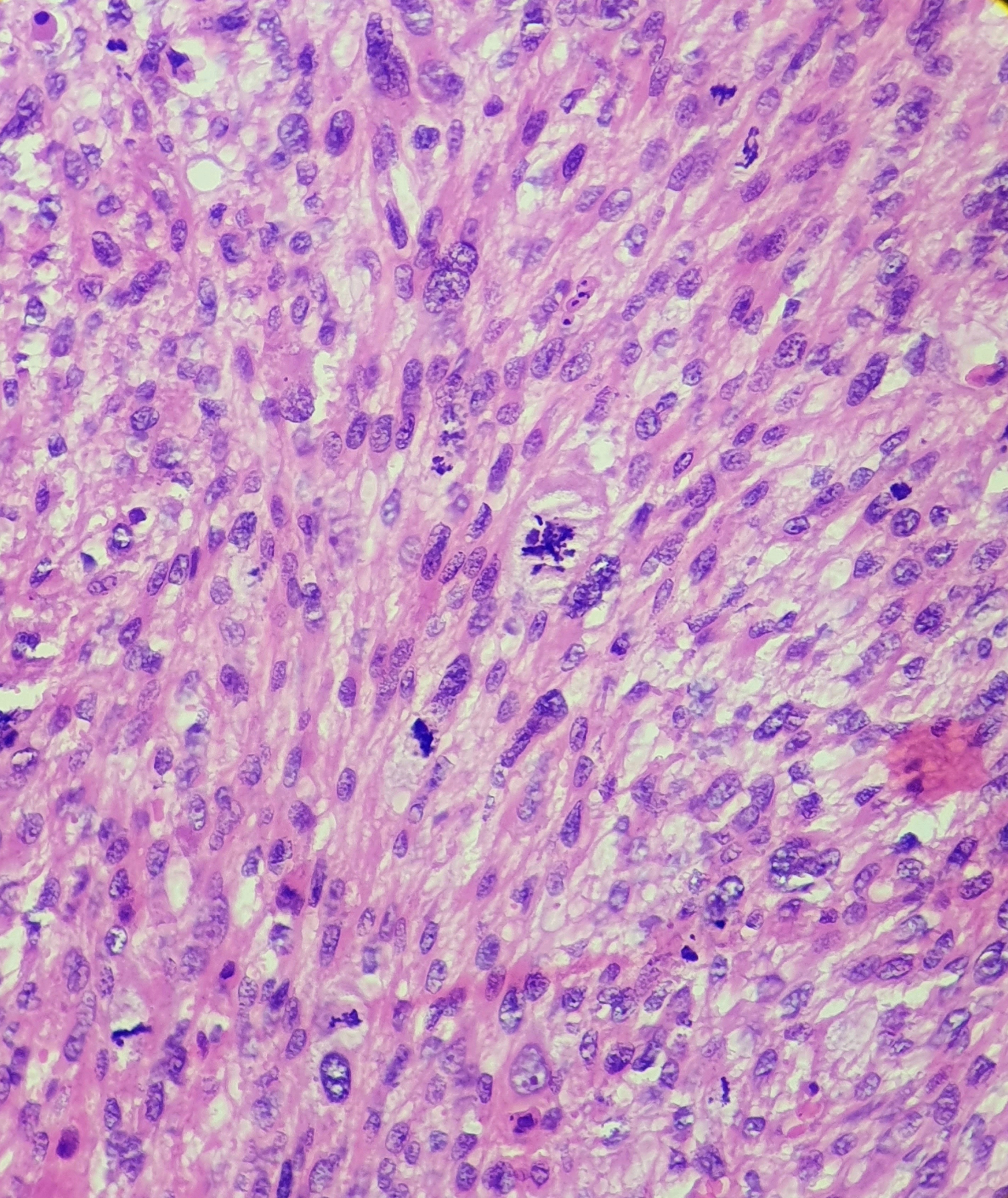 Undifferentiated Pleomorphic Sarcoma. Pleomorphic cells with abundant atypical mitoses.