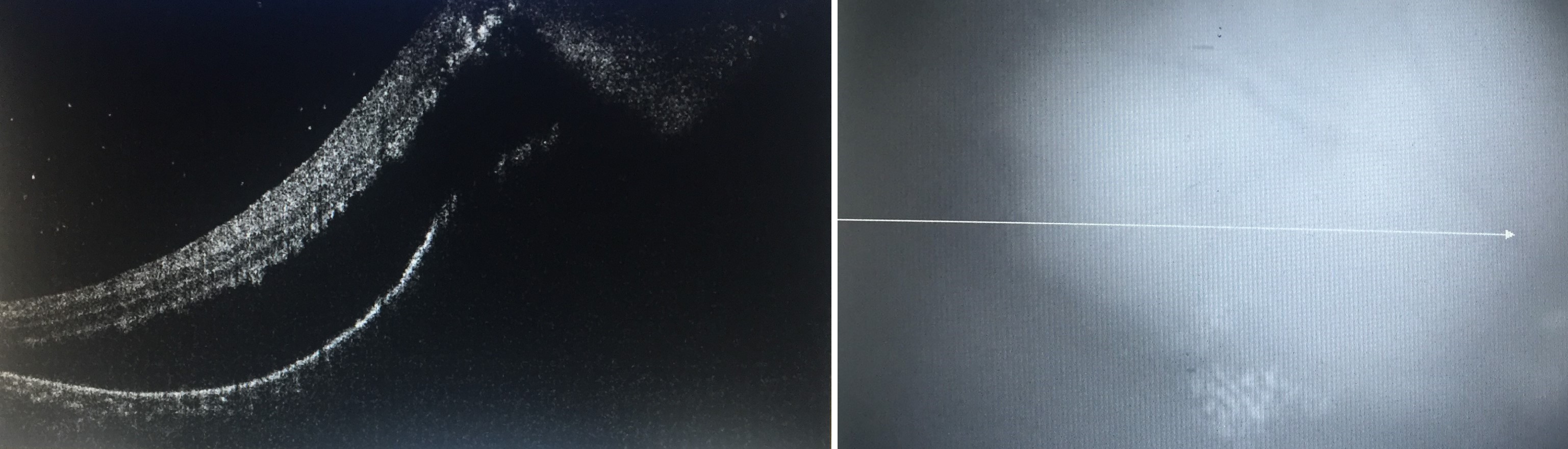 Optical coherence tomography imaging done through a choroidal granuloma (tuberculoma) showing a choroidal mass with retinal e