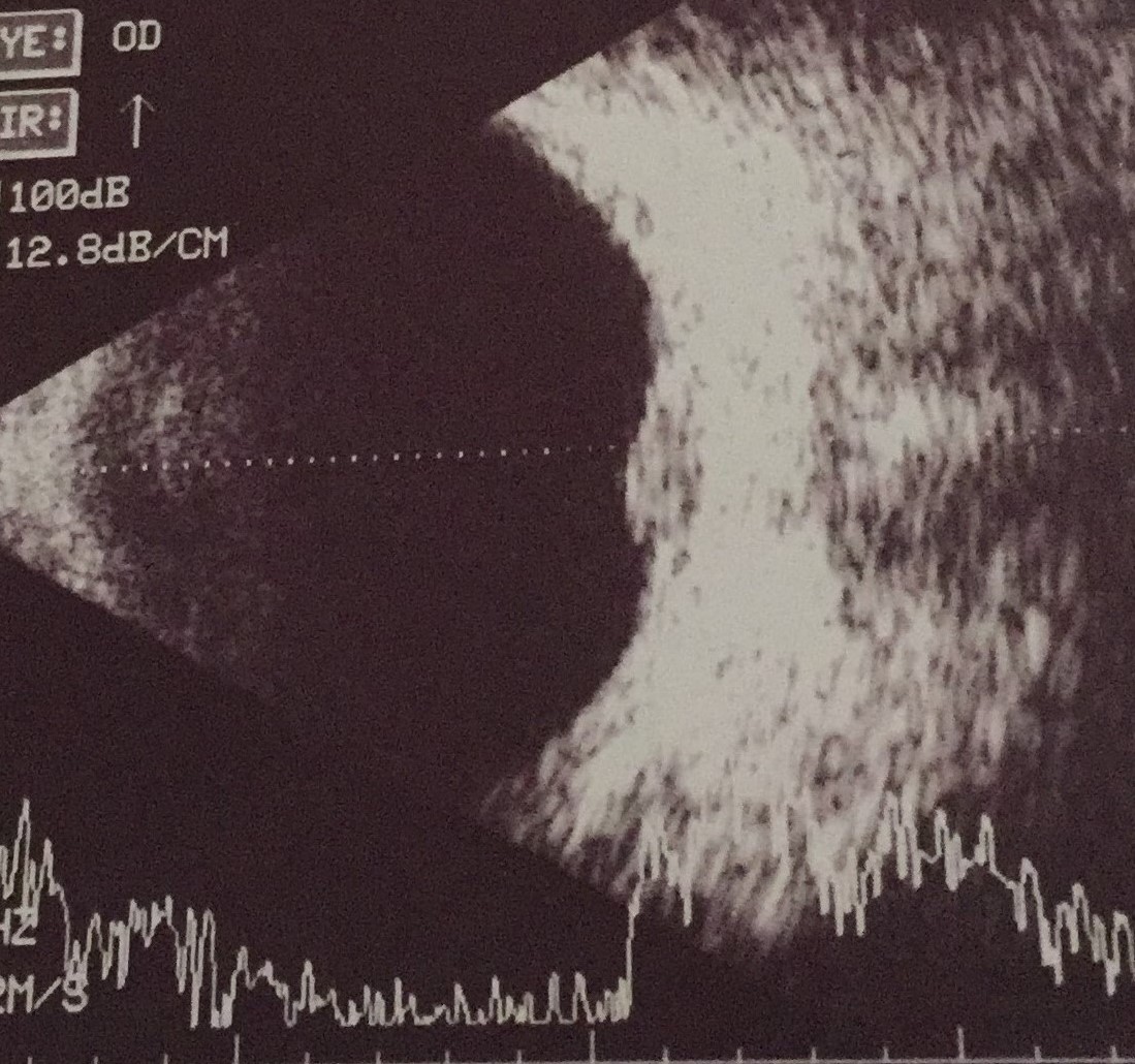 Ocular ultrasonography showing a choroidal mass (choroidal tuberculoma)