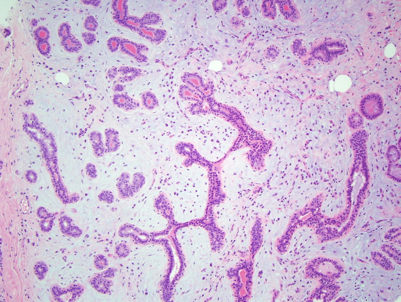 <p>Myxoid Fibroadenoma. Myxoid fibroadenoma shows&nbsp;compression of glands by a blue-tinged myxoid stroma (x10).</p>