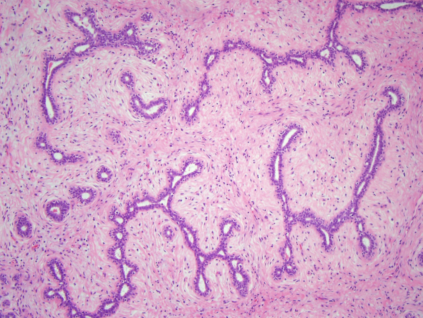 <p>Fibroadenoma With an Intracanalicular Pattern