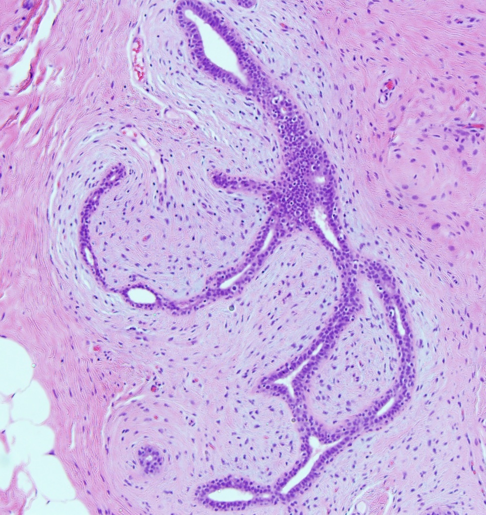 <p>Fibroadenoma With Proliferating Stroma Compressing Glands in the Breast (x10).</p>