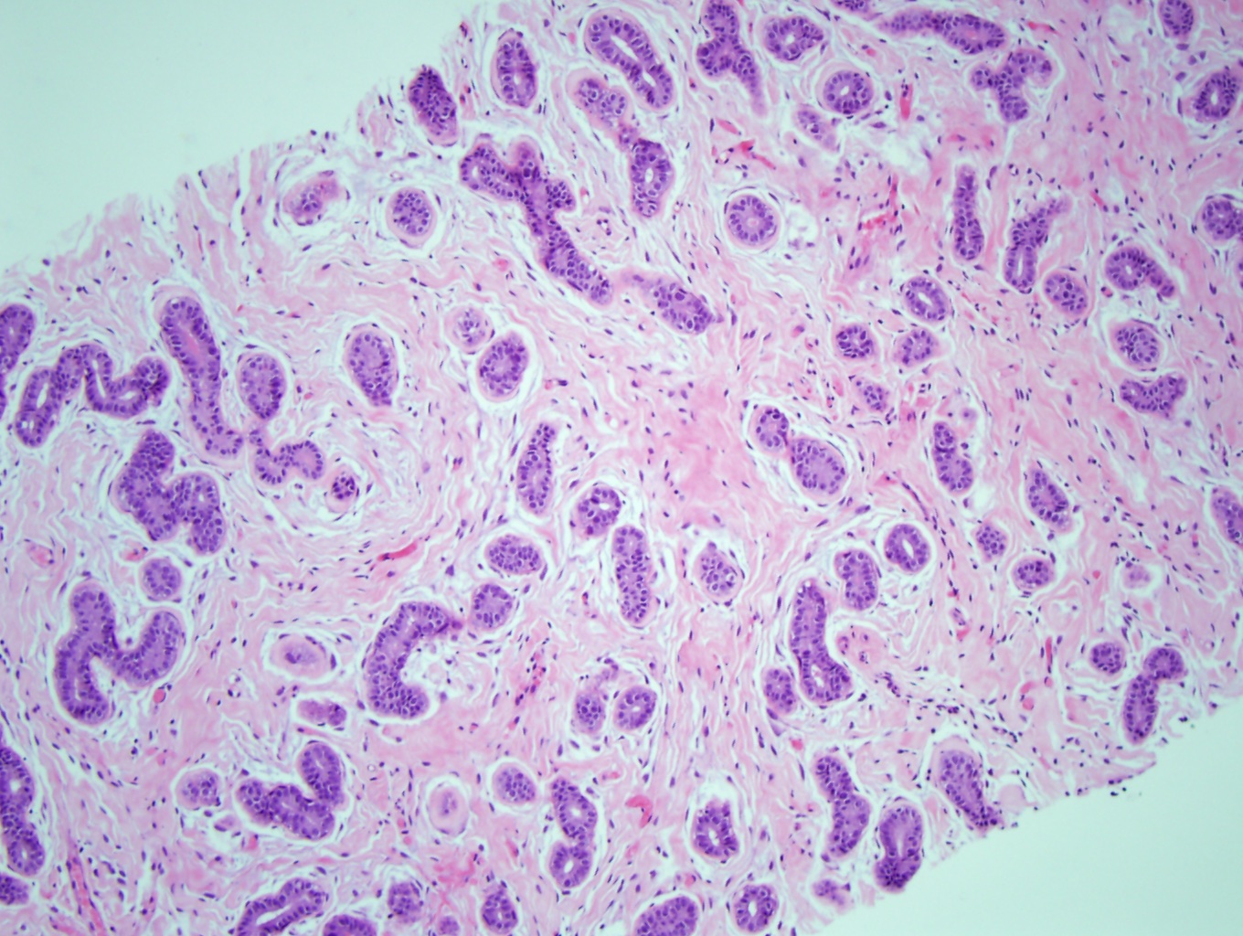 <p>Fibroadenoma With Pericanalicular Pattern