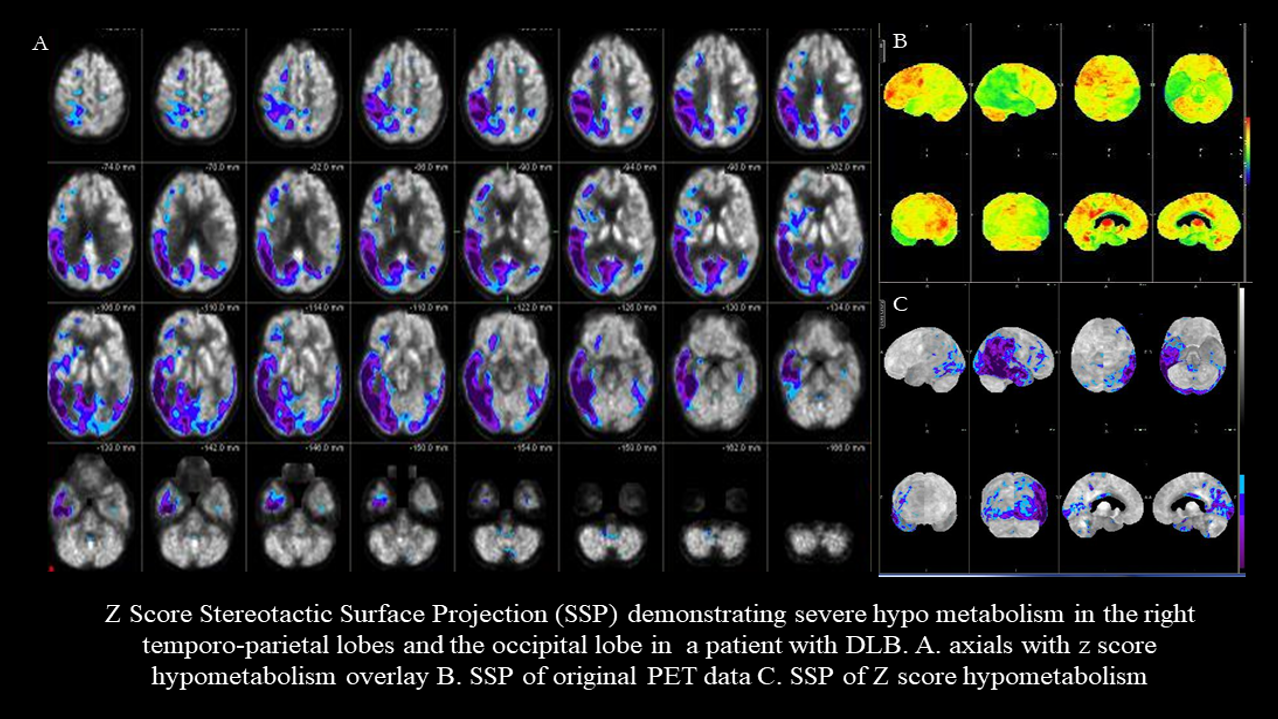 Dementia with Lewy Bodies