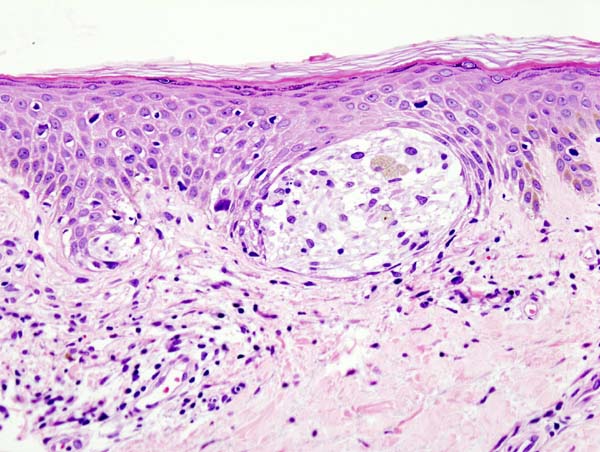 <p>Malignant Melanoma</p>