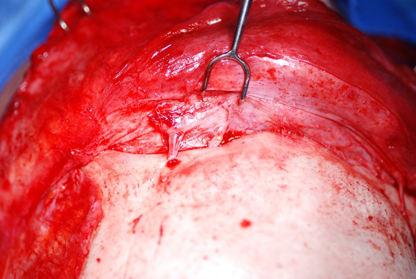 <p>Supraorbital and Supratrochlear Neurovascular Bundles