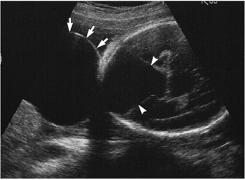 <p>Occipital Meningocele With Dandy-Walker Cyst