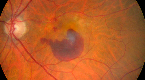 <p>Age-Related Macular Degeneration on Funduscopy