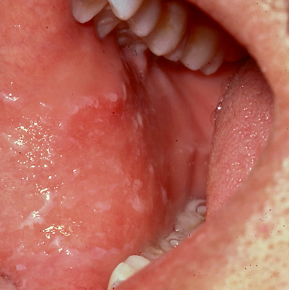 Morsicatio buccarum, aka "cheek biting", present on the buccal mucosa