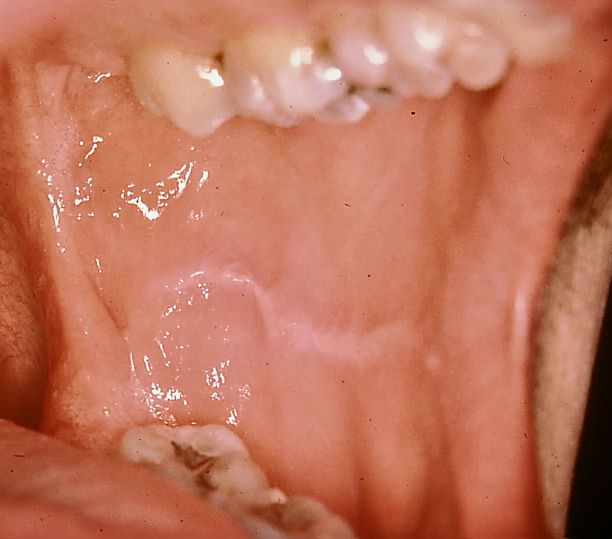 Linea alba present on buccal mucosa