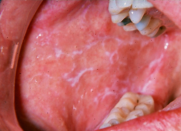 Lichen planus present with Wickham's striae on buccal mucosa