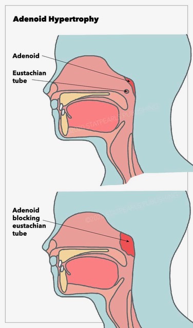 Adenoid Hypertrophy