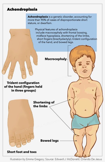 Achondroplasia, trident configuration, macrocephaly, bowed legs, dwarfism, frontal bossing