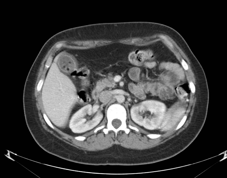 <p>Abdomen CT,&nbsp;Acute Cholecystitis</p>