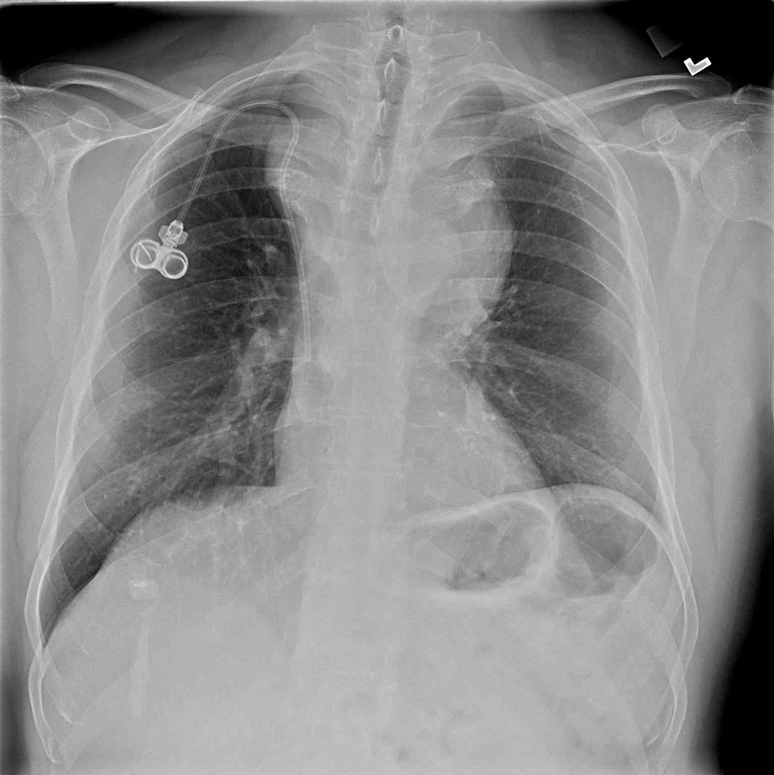 <p>Anterior Mediastinal Mass, Chest X-ray.</p>