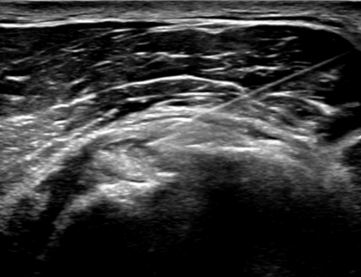 Ultrasound-guided barbotage of the supraspinatus tendon.