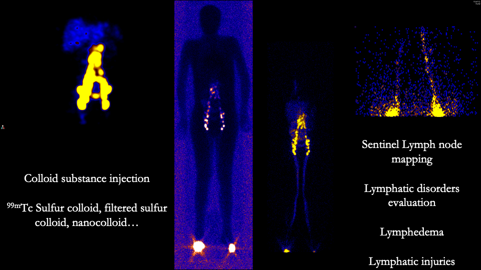 <p>Lymphoscintigraphy. Typical Normal Lymphoscintigram.</p>