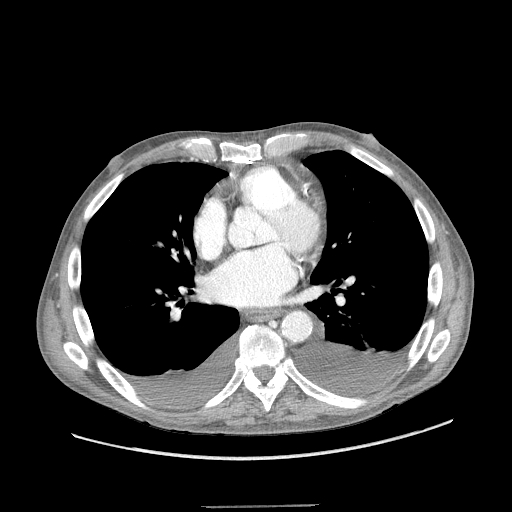 <p>Chest CT,&nbsp;Bilateral Pleural Effusions</p>