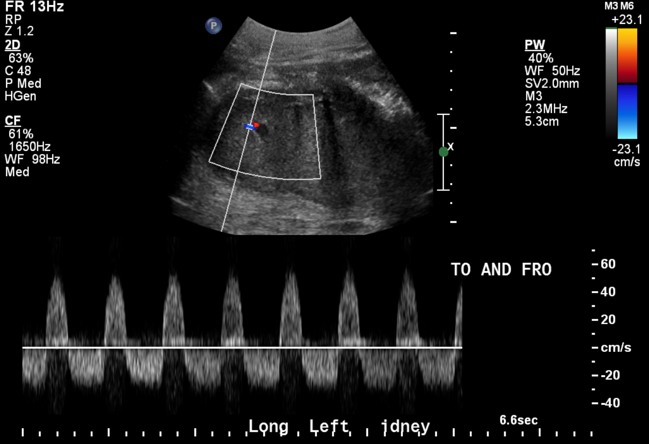 Spectral Doppler shows "To-and-fro" waveform associated with a pseudoaneurysm