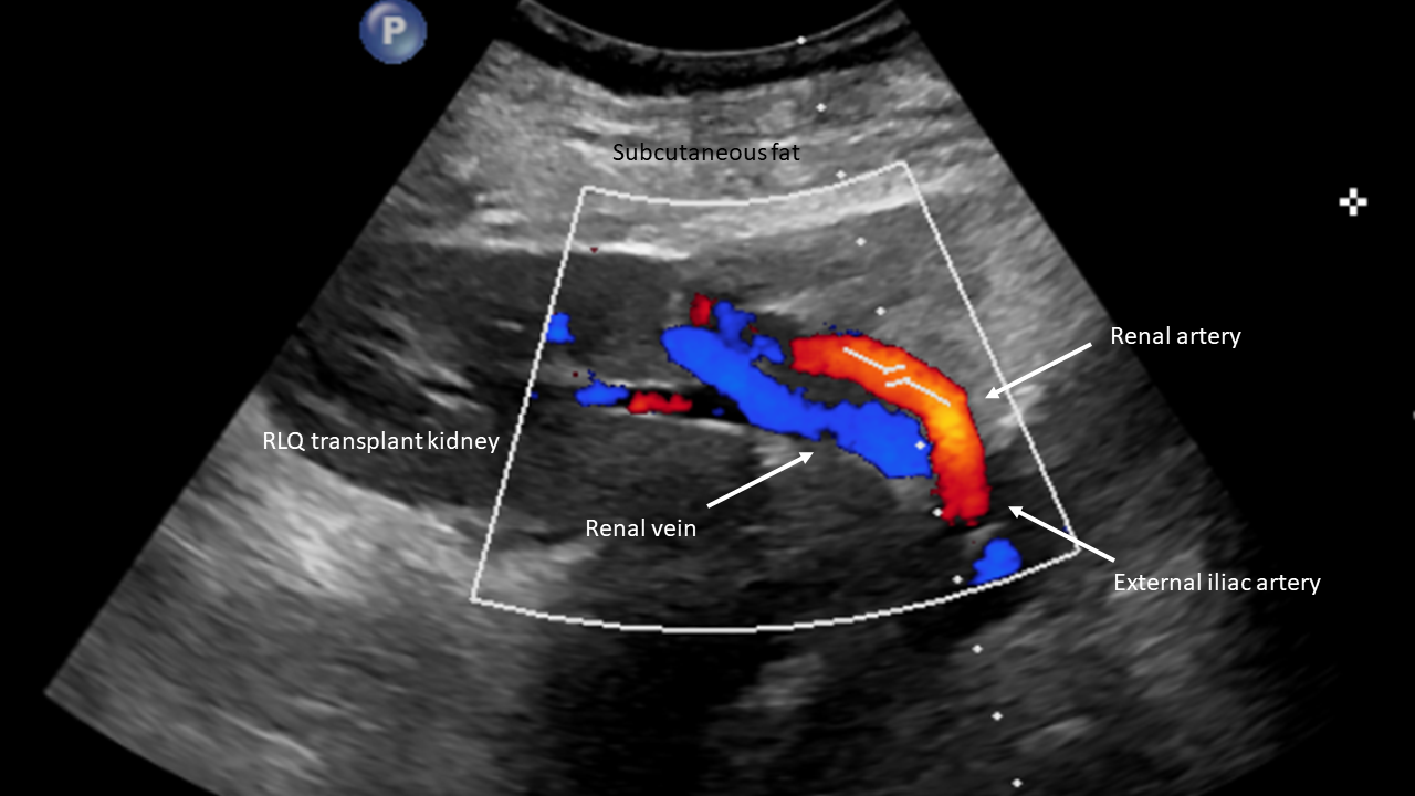 Renal vascular anatomy illustrated in a right lower quadrant transplant kidney with the external iliac artery representing the vascular anastomosis site