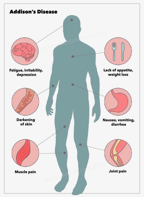 Addison's Disease symptoms