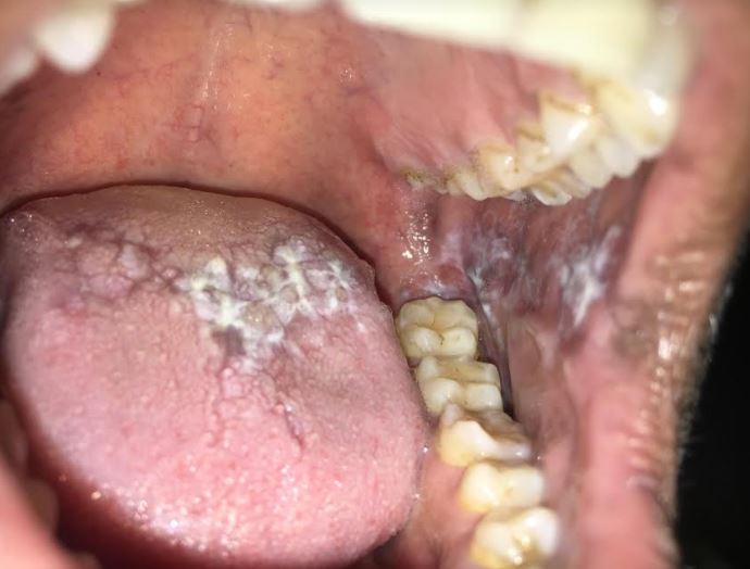 Oral lichen planus