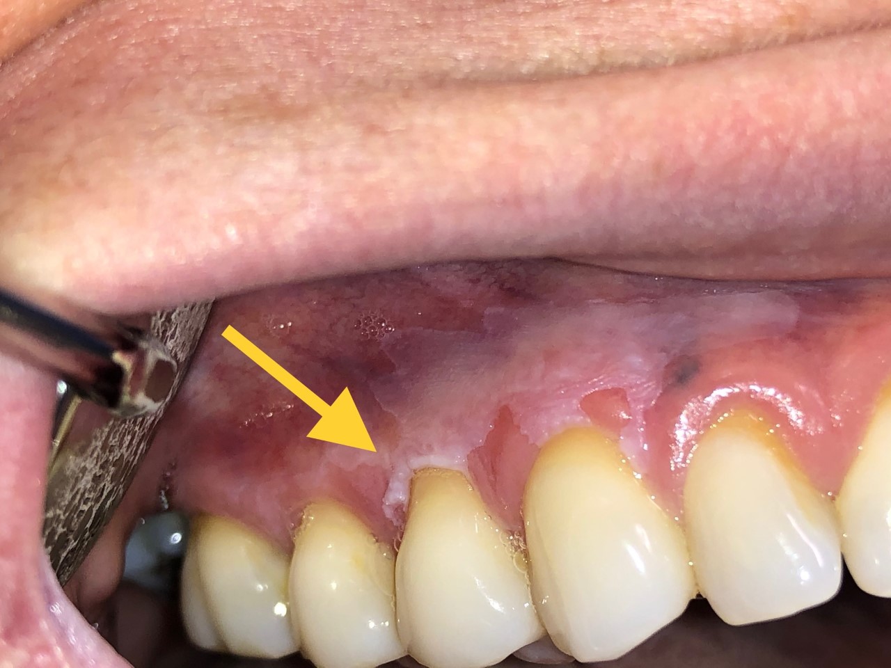 Leukoplakia of the gingiva