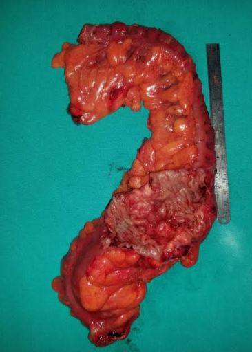 <p>Left Hemicolectomy Specimen.</p>