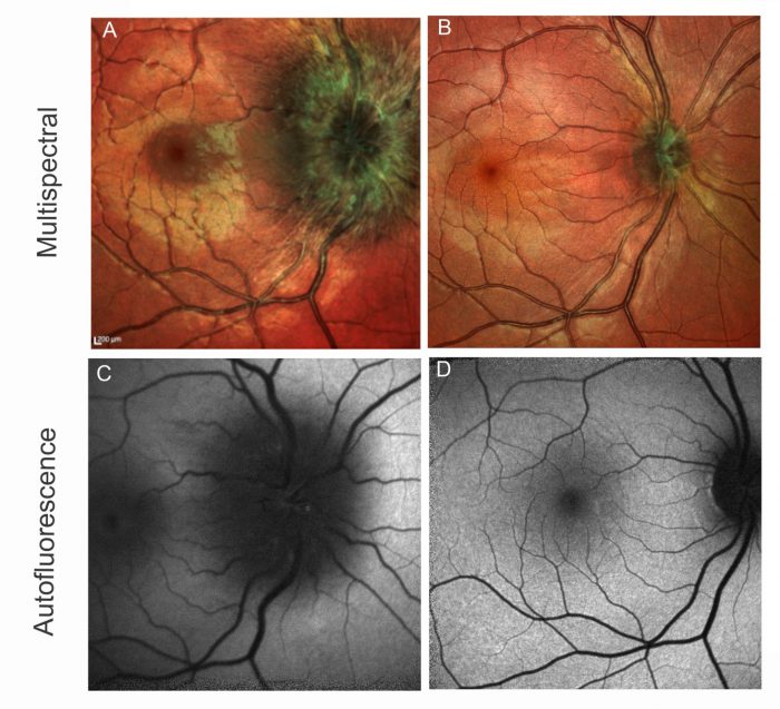 Neuroretinitis in an 18-year-old female who presented with vision loss in the right eye, headaches and severe photophobia

