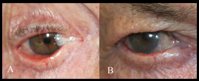 Patient one year after reconstruction of the right superior and inferior fornix, bulbar scarring, double vision and corneal scarring