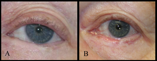 Repair of cicatricial lower eyelid entropion with mucous membrane graft

A: Patient with ocular cicatricial pemphigoid that