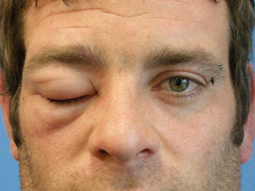 <p>Angioedema</p>