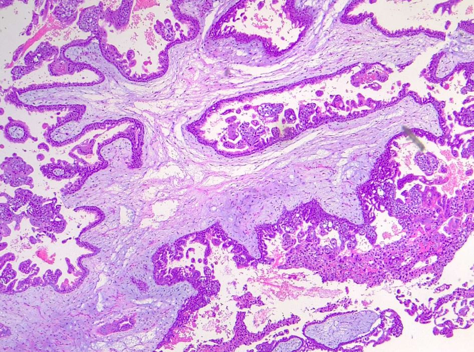 <p>Dysmorphic Villi in Hydatiform Mole. H/E 4x</p>