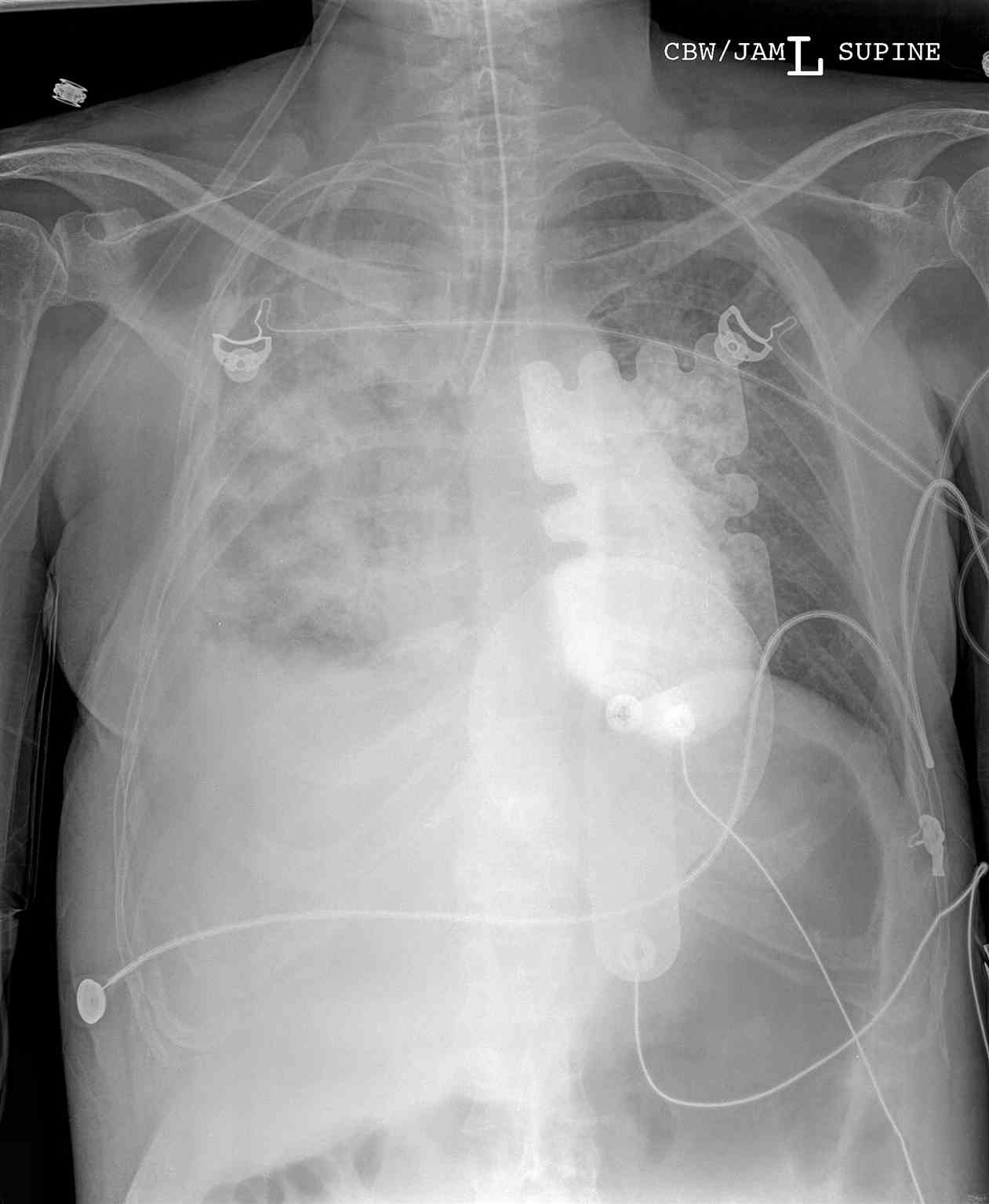 <p>Chest Radiograph, Endotracheal Tube Right Mainstem Bronchus</p>