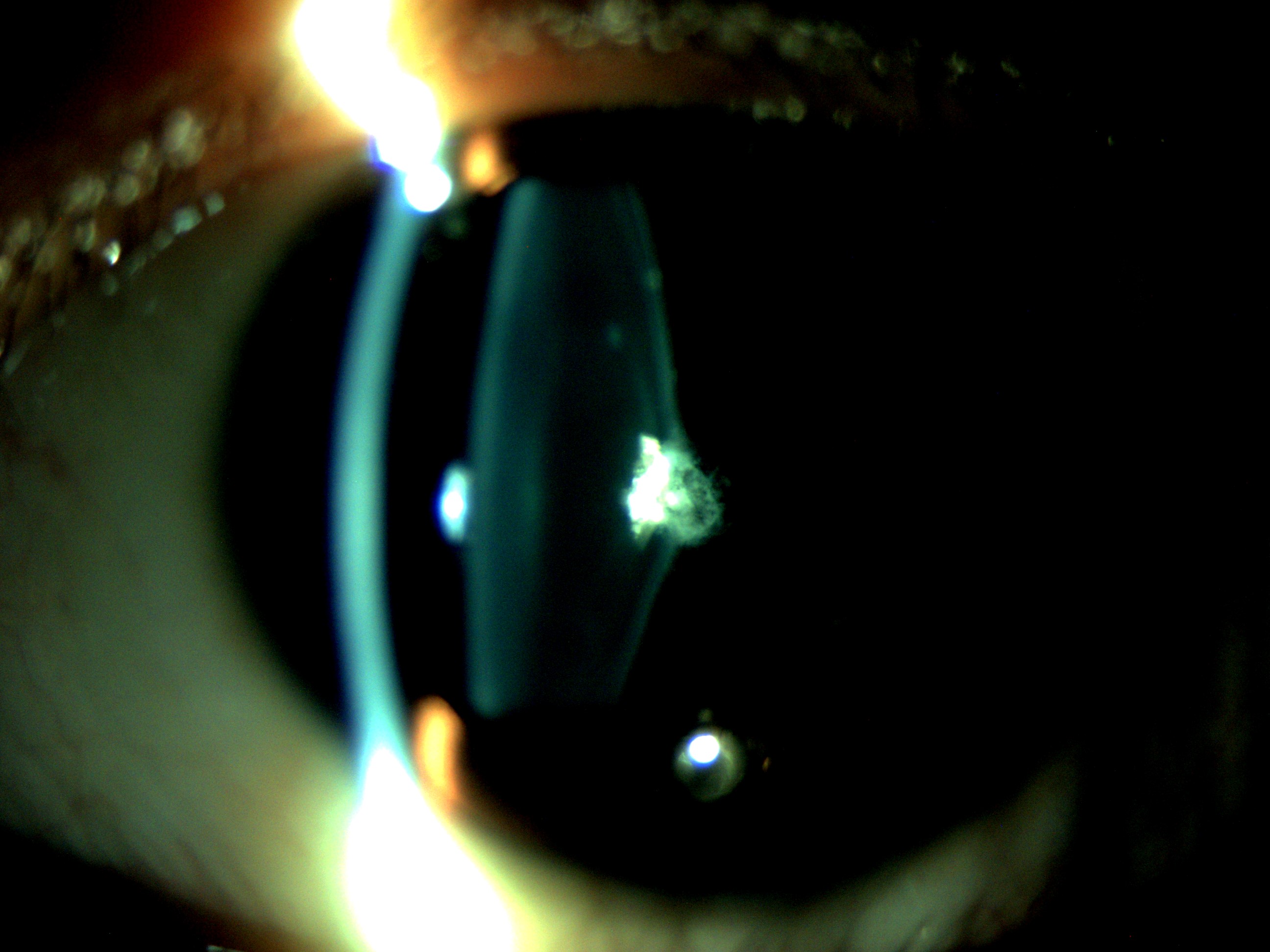 <p>Pediatric Cataract, Posterior Lenticonus