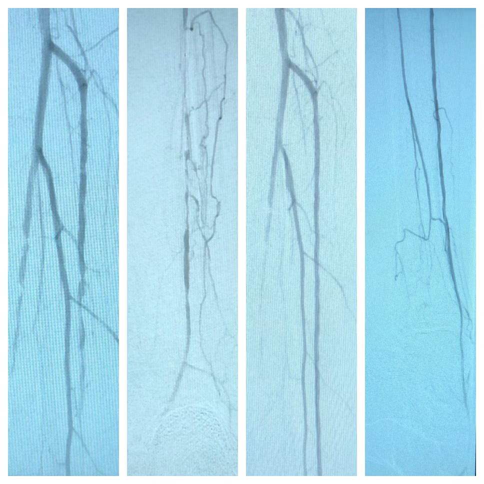 Peripheral Arterial Disease - Occluded anterior tibial artery