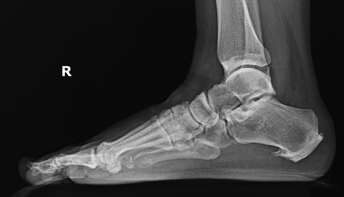 <p>Plantar Heel Pain