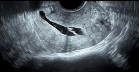 Figure 15: Saline Infusion Sonogram (SIS) showing intrauterine adhesions